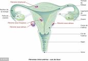 Uterine flesh tumour lifestyle hides trap